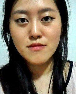长脸 埋线法双眼皮 隆鼻 额头脂肪移植整形