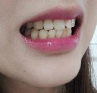 laminate牙齿矫正 冷光美白治疗后记