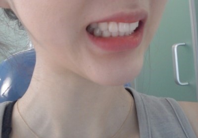 laminate牙齿矫正 冷光美白治疗后记