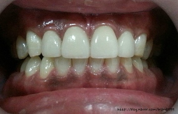 Laminate牙齿矫正+冷光美白整形后记