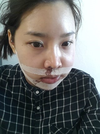 面部不对称+棱角下巴整形手术+下颚内缩5天后