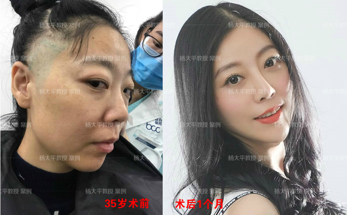 macs小切口除皱术