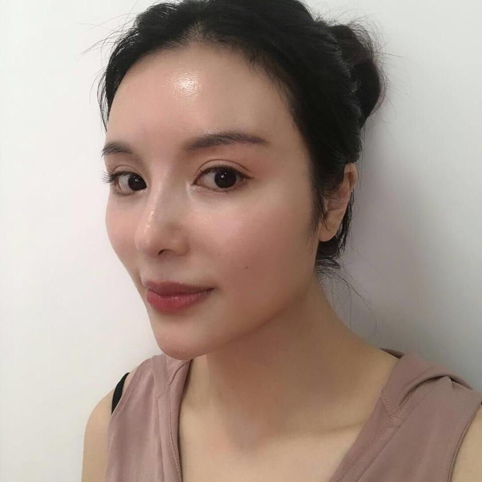 玻尿酸丰额头_整形日记_整形前后对比图_整容效果