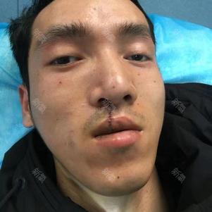 奋斗8少年的美丽日记"12.8"手术祛疤
