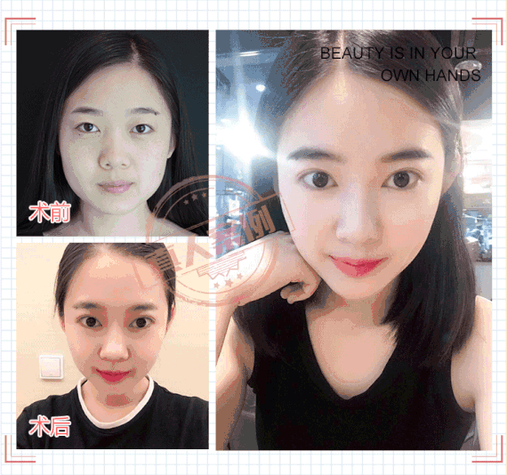【除皱瘦脸】【衡力瘦脸针】衡力肉毒瘦脸 瘦咬肌 下颌缘注射塑形