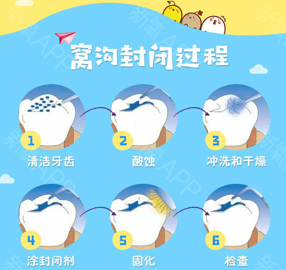 130家连锁!儿童窝沟封闭套餐,保护牙齿,拒绝蛀牙
