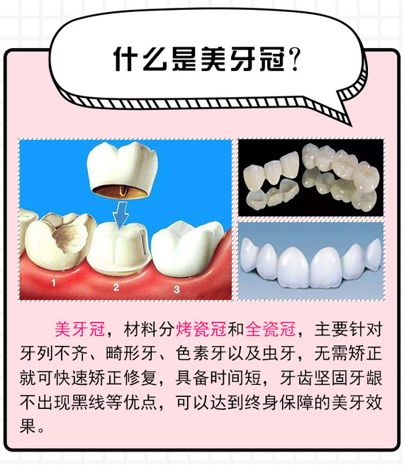 【全瓷牙】黄牙黑牙美白,缺损牙,龋坏牙修复,牙齿局部