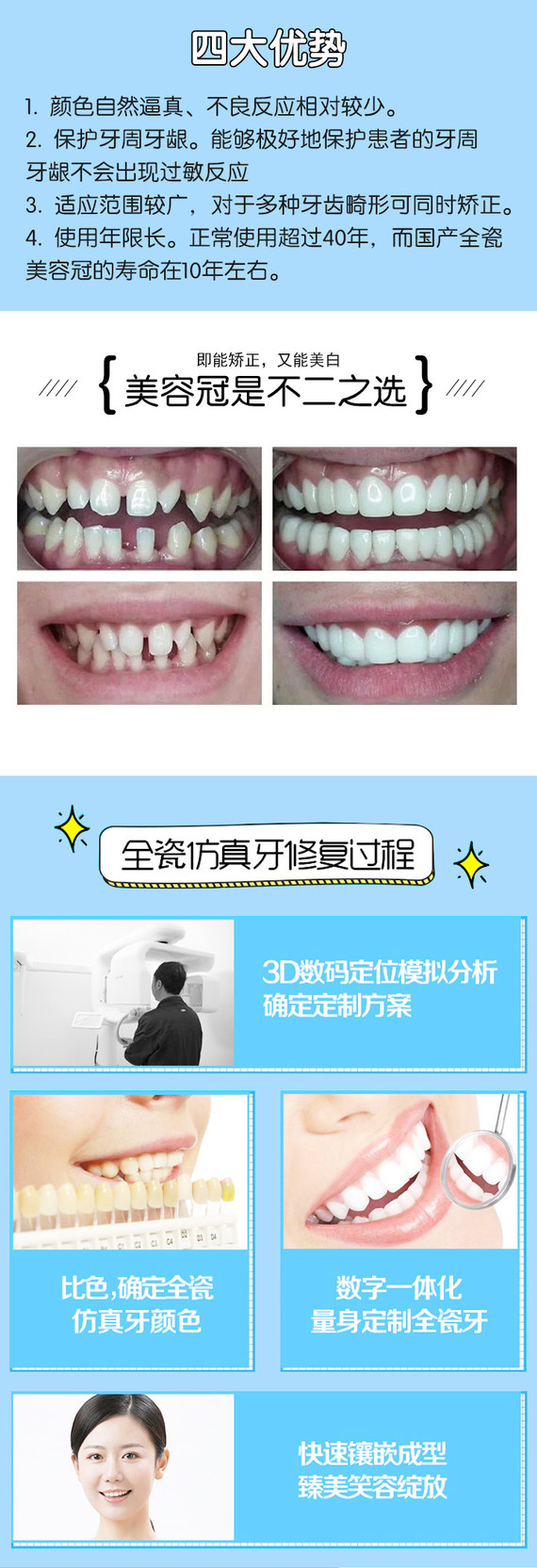 【贵金属烤瓷牙】【钴铬烤瓷牙】镶牙 牙冠 全瓷冠美容修复 合金烤瓷