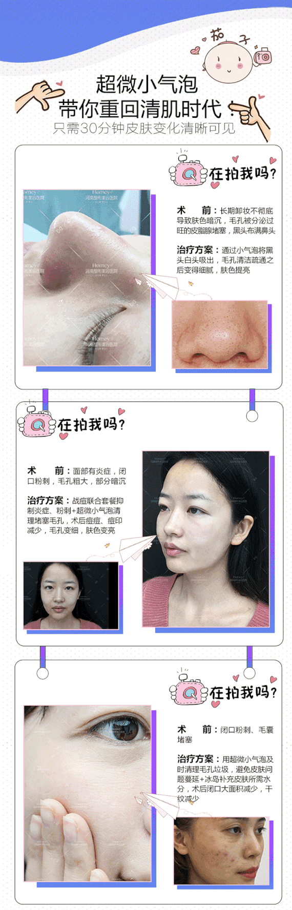 【超微小气泡】【超微小气泡】深层清洁 去黑头粉刺 不伤肌肤