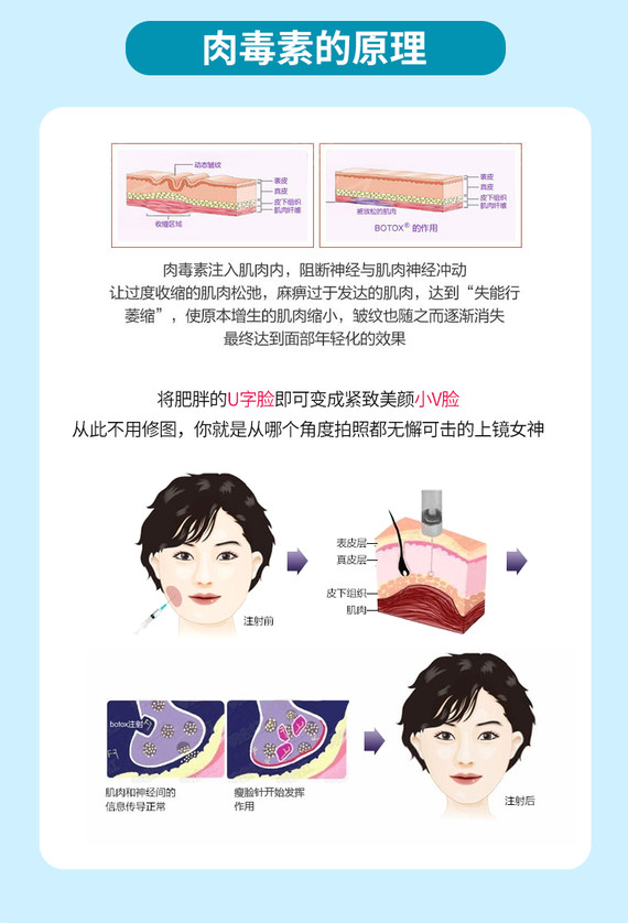 【安心医美节】【肉毒素】【公立医院 安全整形】肉毒素瘦脸 瘦脸针