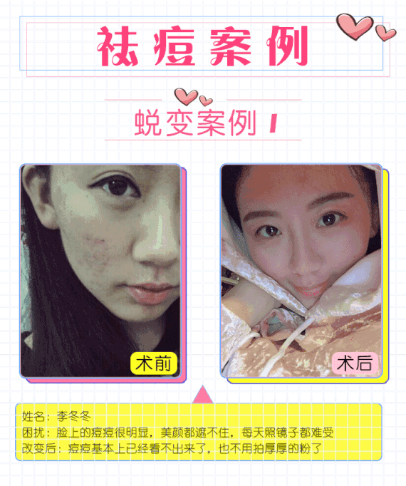 【果酸焕肤】【祛痘套餐】果酸换肤 针清 红蓝光 专业