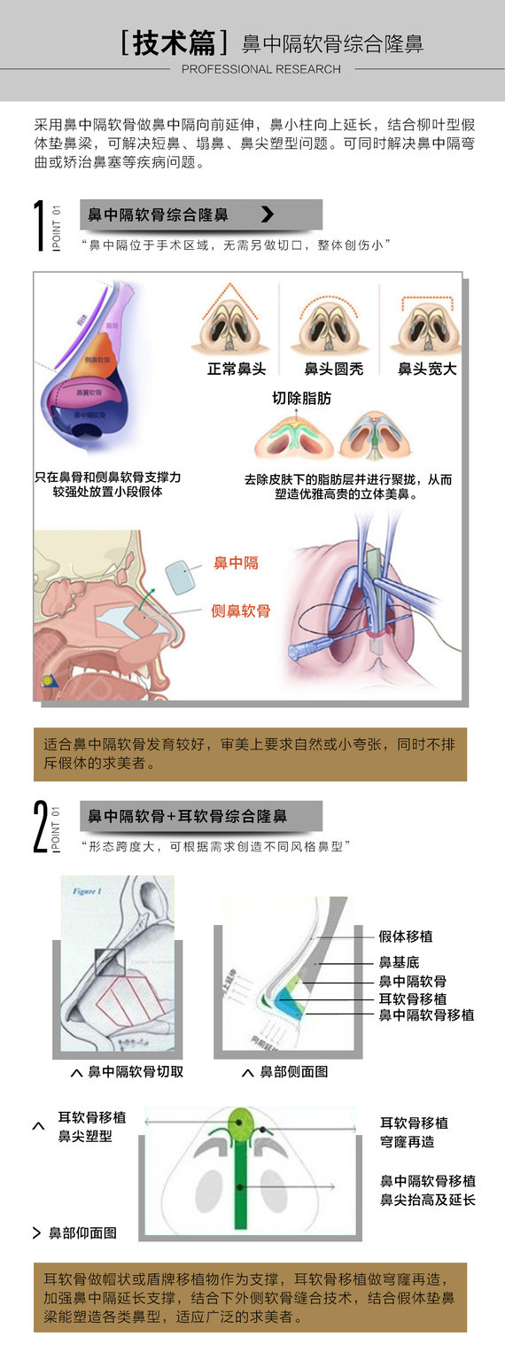【鼻综合】【鼻中隔综合隆鼻】①榫卯结构形态自然②7