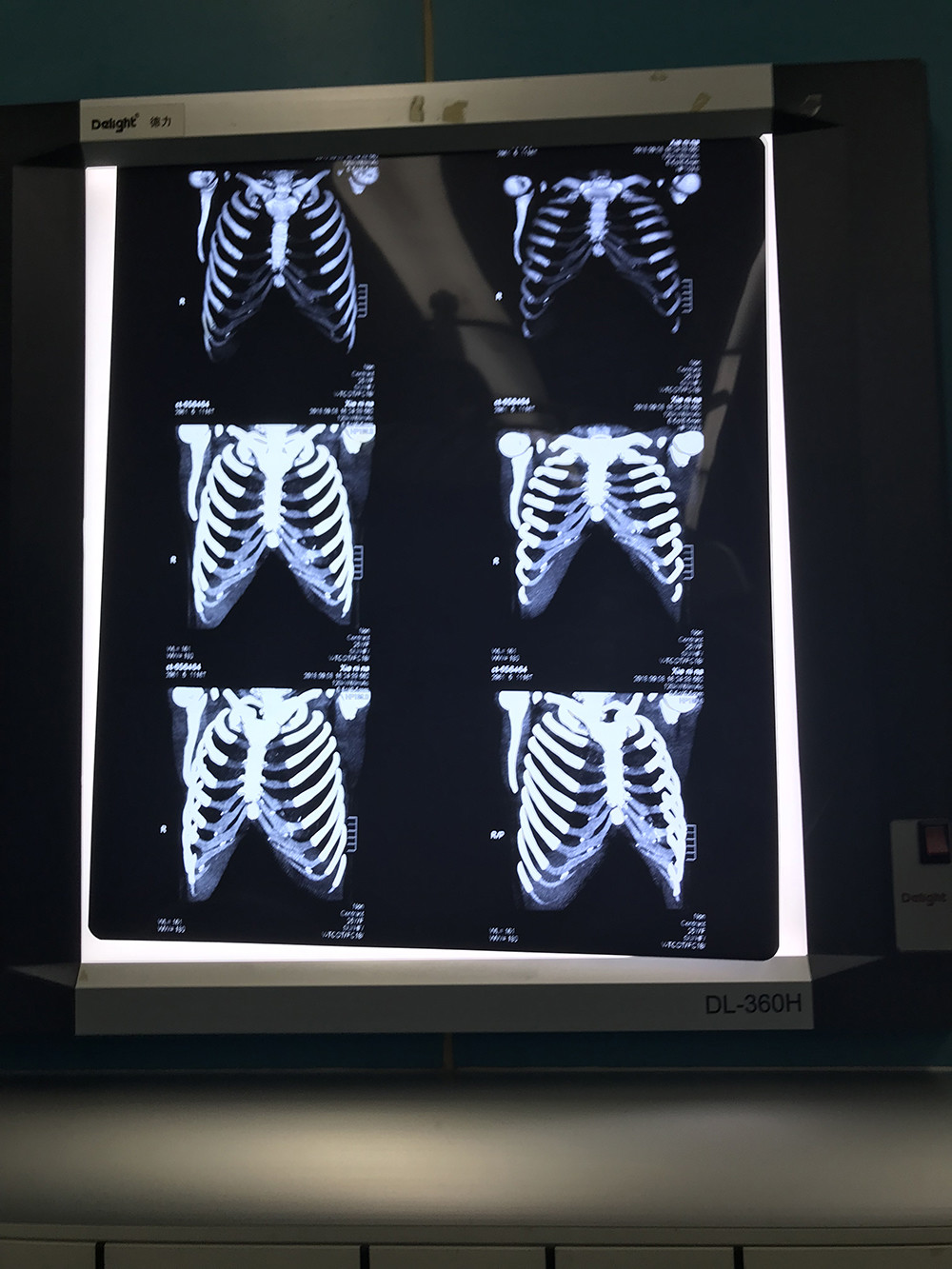 远期效果稳定同时在患者术前检查拍摄的肋部的三维重建的 图像来看