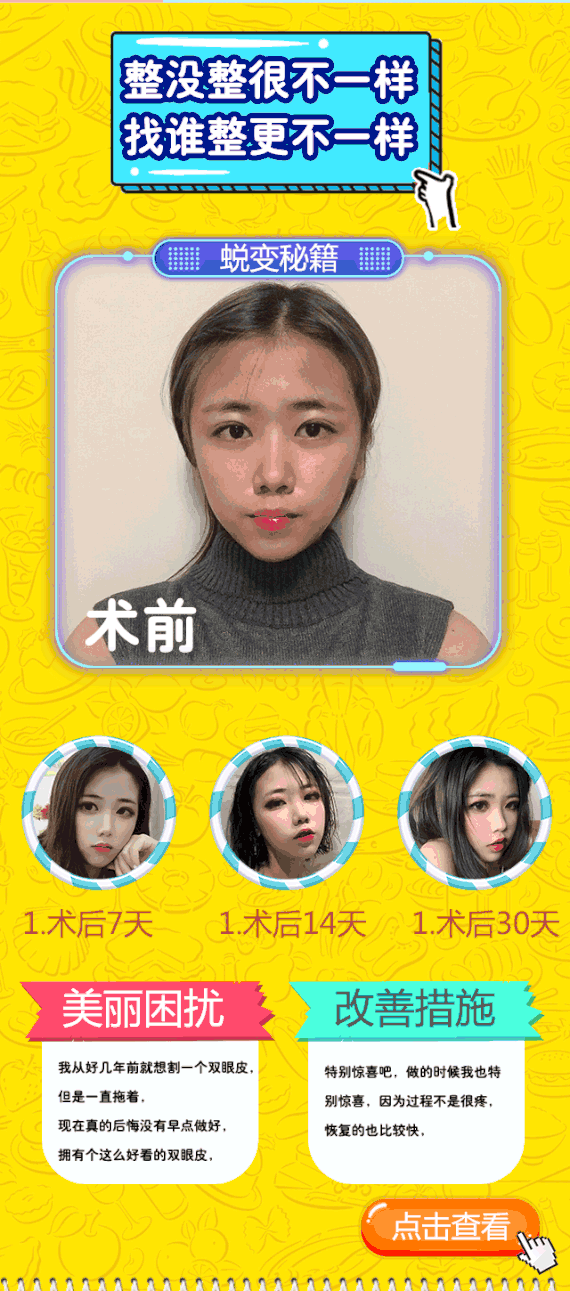 【埋线双眼皮】睁眼有神 闭眼无痕 多点分层定位 不开刀恢复快 定制