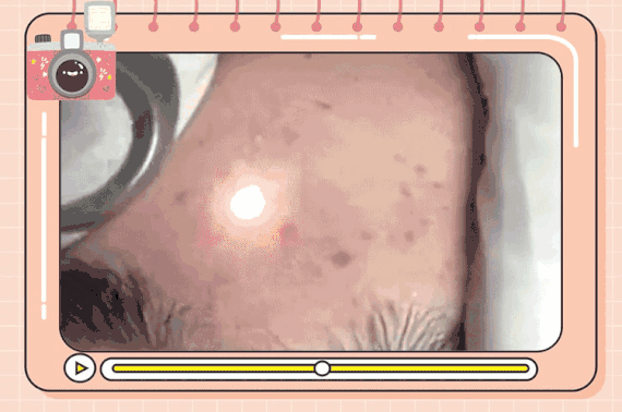 【激光祛斑】(蜂巢皮秒)重塑瓷感裸机 告别缺憾 做