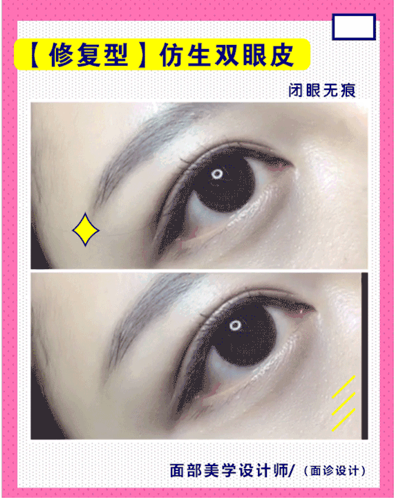 独有:多层处理,减张缝合,睁眼自然,闭眼干净平滑,无肉条,切口平