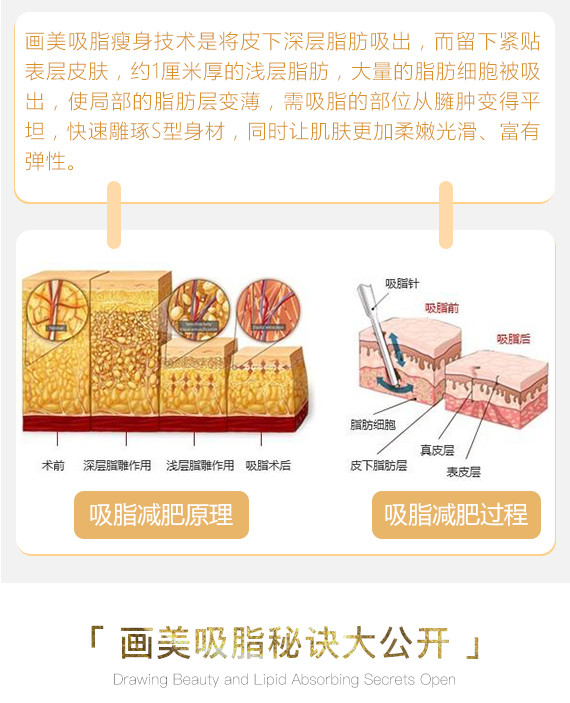 【吸脂】腰腹 ,腰腹环吸7800/大腿环吸8800,西安技术领航医院