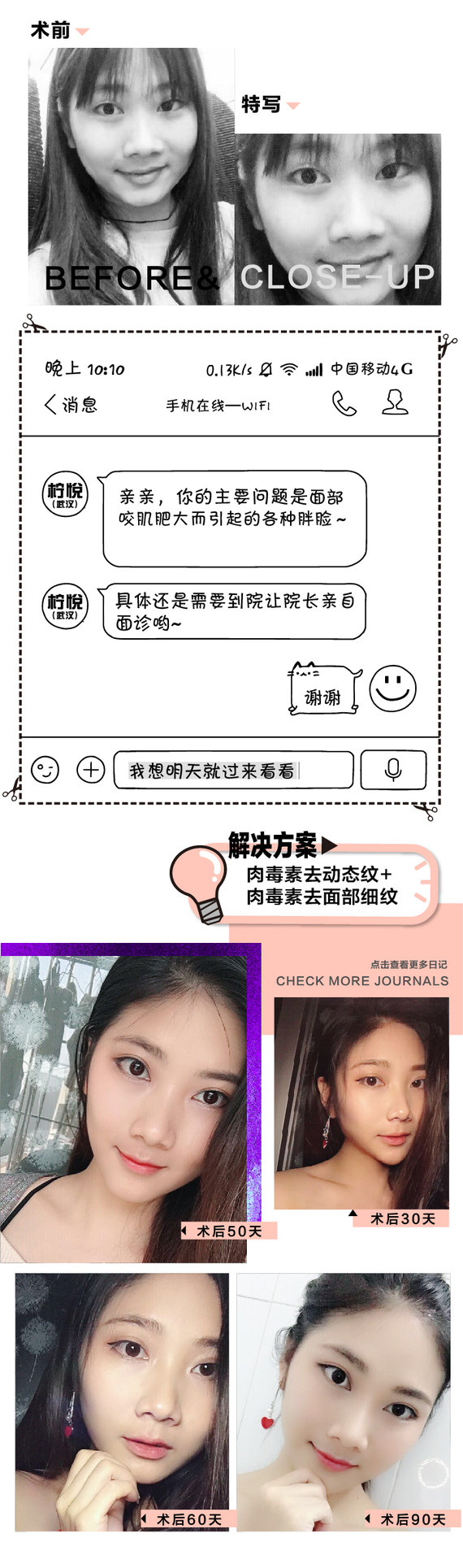 【取颊脂垫瘦脸】新年瘦脸 去颊脂垫瘦脸