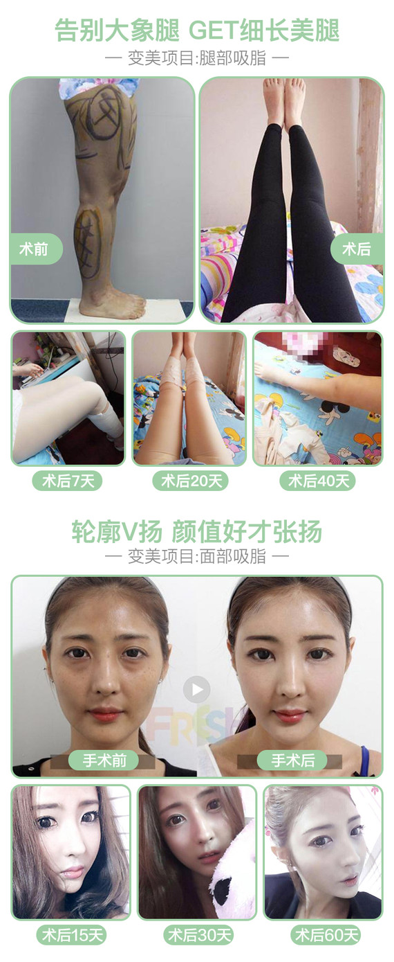 【吸脂】大腿环吸/腰腹环吸/手臂吸脂 多隧道分层柔性