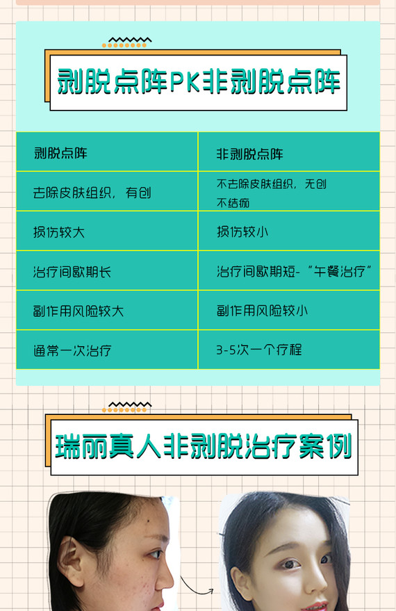 【点阵激光】【激光祛痘祛痘印】高级非剥脱点阵激光