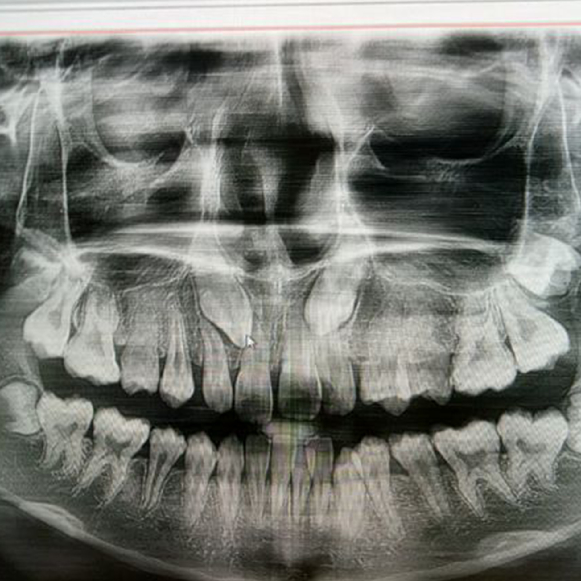顾客 23 岁,牙齿有点前凸,中线偏移,牙列不整齐;  通过 ct 片观察