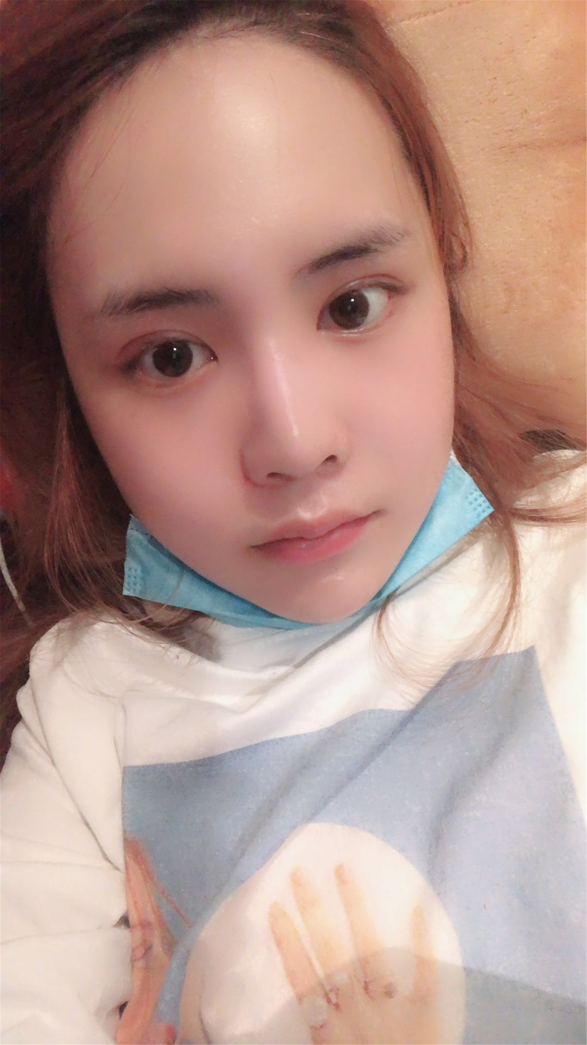 完全消肿后,患者自拍反馈