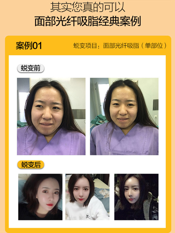 【光纤溶脂瘦脸】【单部位】告别大饼脸 定义v脸女神新标准