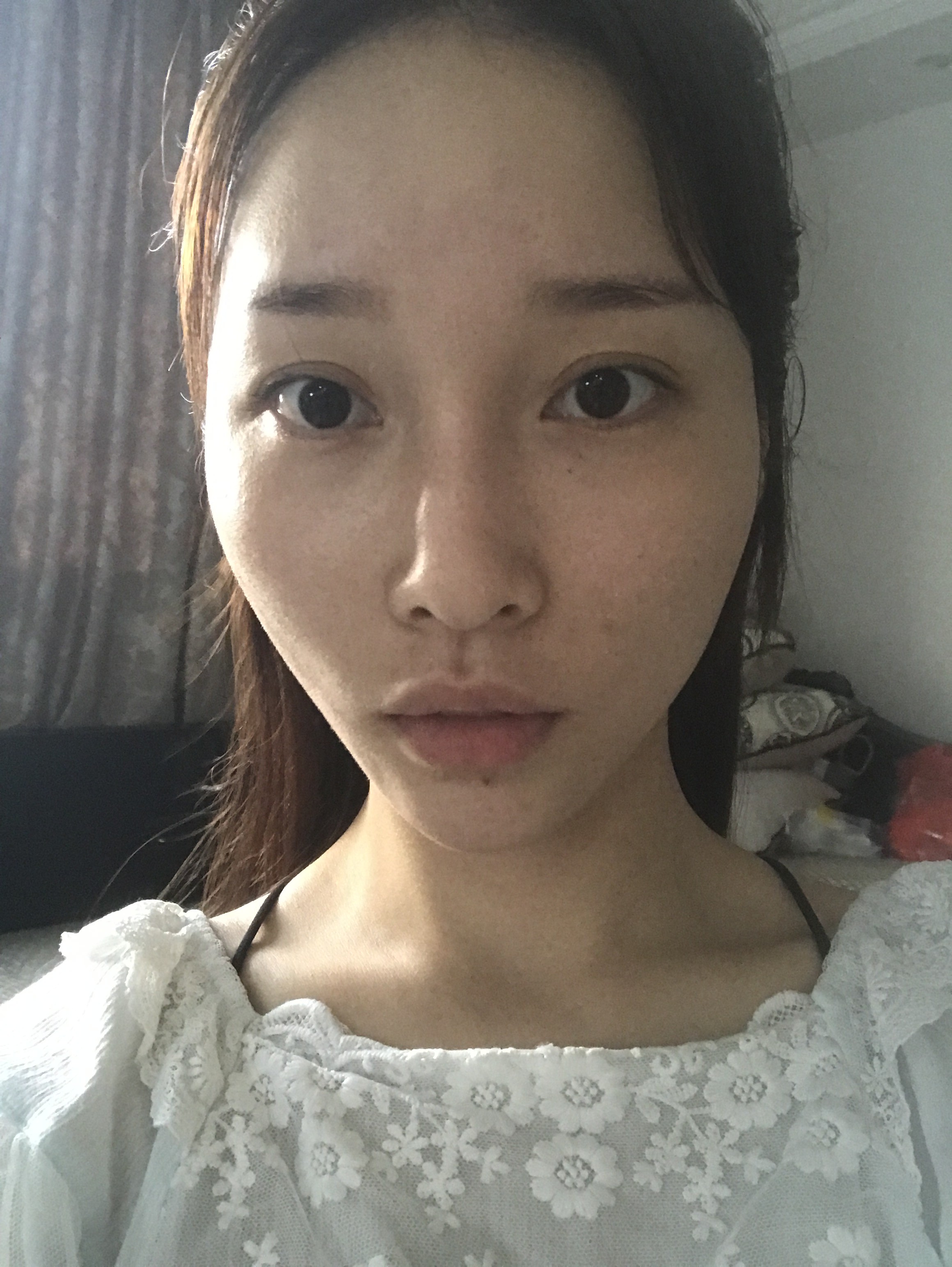 面颊凹陷,面部扁平 4. 下巴短小,三庭比例不协调
