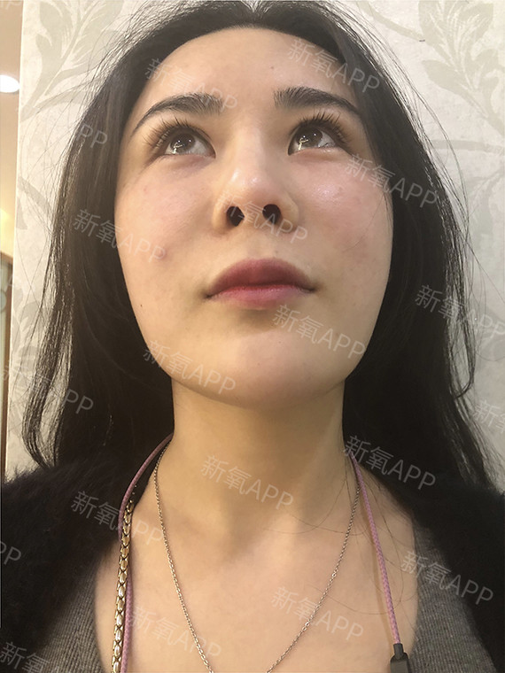 手术时长3小时术前照片术后照片报告亮点1,自体耳软