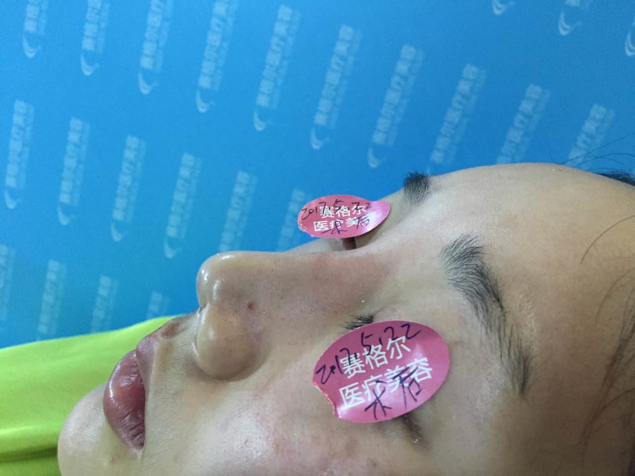这是修复手术结束后拍摄的术后即刻照片