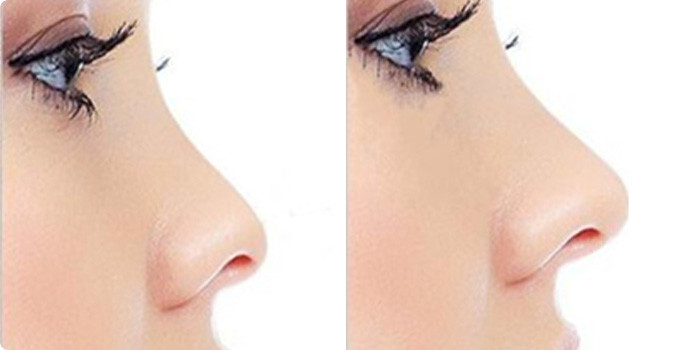 硅胶隆鼻案例效果对比图