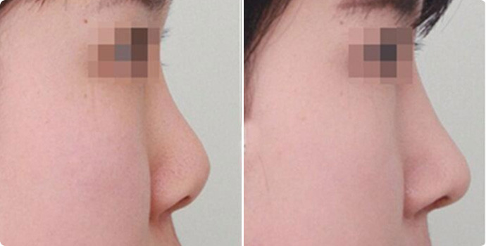 硅胶隆鼻案例效果对比图
