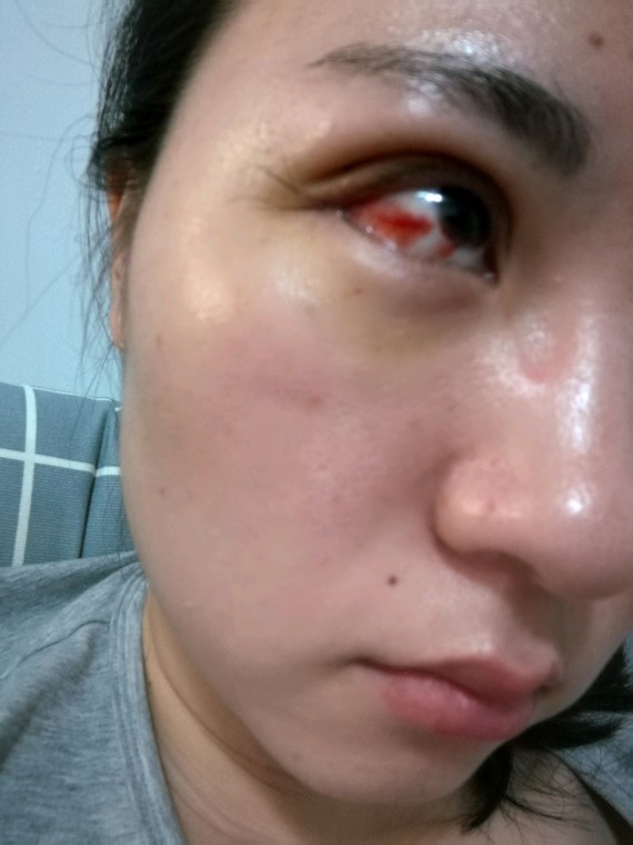 新氧 氧气4535861496738668 眼部 开眼角 双眼皮 开外眼角