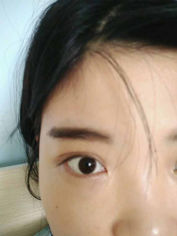 我天生也是双眼皮,左眼是三四层那种双眼皮_圈子-新氧