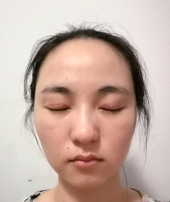 眼部 | 开眼角 | 双眼皮 | 开外眼角 | 埋线双眼皮 | 切开双眼皮