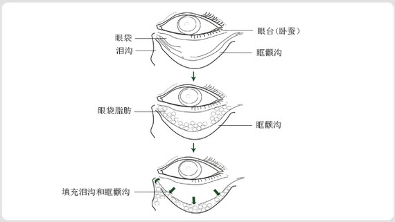 眼袋的表现形式多种多样,根据眼睑部皮肤,眼轮匝肌