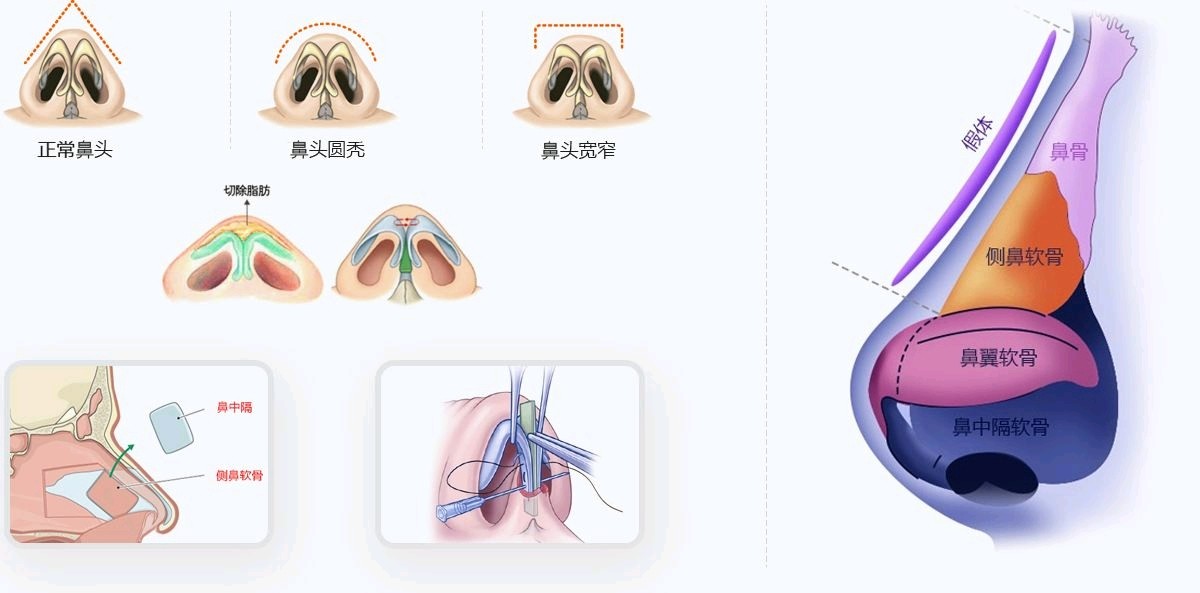 鼻中隔软骨耳软骨综合鼻整形