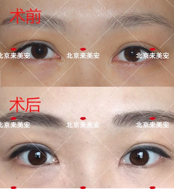 您好,内眼角开大了是可以修复的.