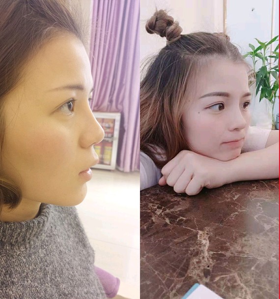 硅胶隆胸假体:十年硅胶假体的使用年限基本都