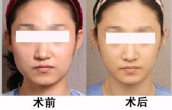 打完瘦脸针后千万不要进行对面部的按摩,以防英国hb减脂片图片