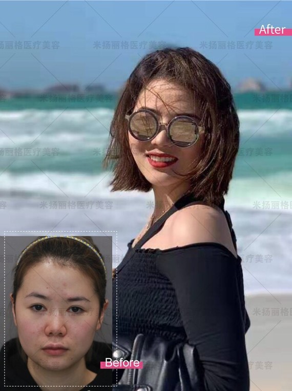 做鼻综合七天拆线就消肿60%左右,可以出门见