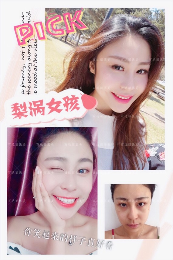 你好,恢复期内会硬,正常的伤口愈合过程,一般1-3个月左右会完全恢复.