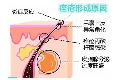 酸能从源头抑制痤疮,改善皮脂腺增生导致的出油过剩和毛孔堵塞.