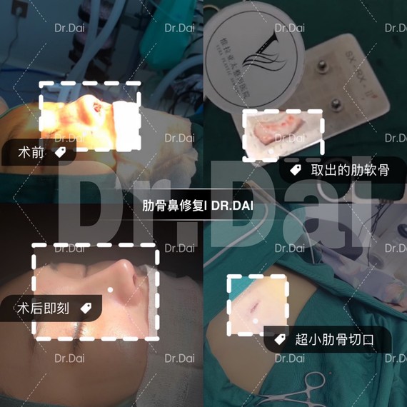 全肋软骨隆鼻,鼻尖和鼻背均使用自体肋软骨完成手术.