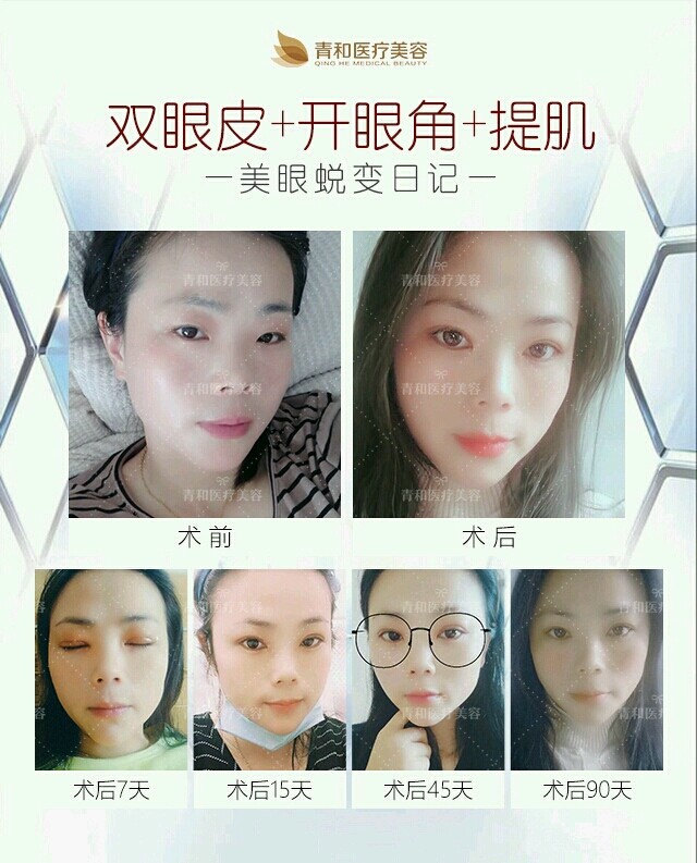 金鱼眼的人其眼球外凸,若做双眼皮,必然使人觉得眼球愈加外突,反彰其