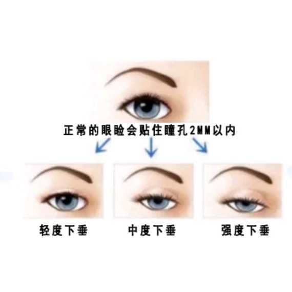 上睑提肌手术是什么?