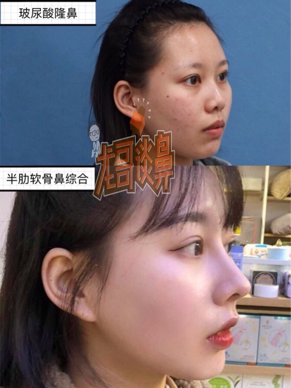 【龙哥谈鼻】玻尿酸隆鼻会导致鼻背变宽,玻尿酸鼻头鼻尖塑形效果比较