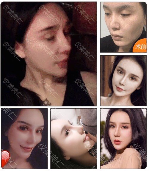 鼻综合术后13天,目测鼻头出现歪斜,鼻孔一大一小,鼻孔外露,是不是