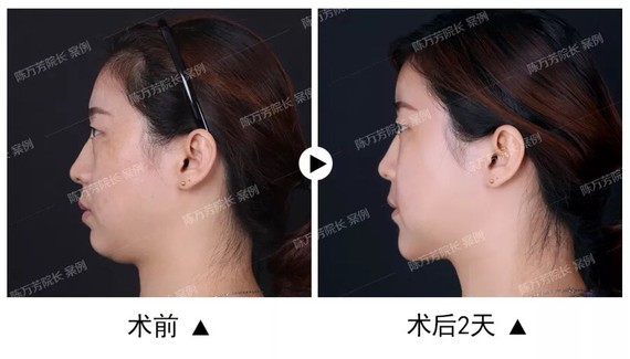 视频,针对双抽脂你好更稳妥一些。要去除双下pl.下巴图片