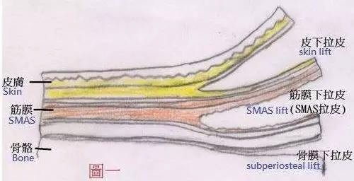拉皮手术提升  在全面部和颈部皮下脂肪层进行分离的单纯皮肤提紧切除